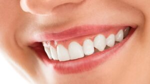 Diş Eti Seviyeleme Kimler İçin Uygundur?