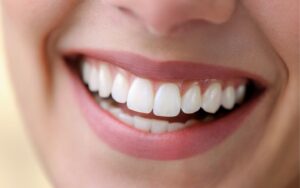 Diş Eti Seviyeleme Nedir?