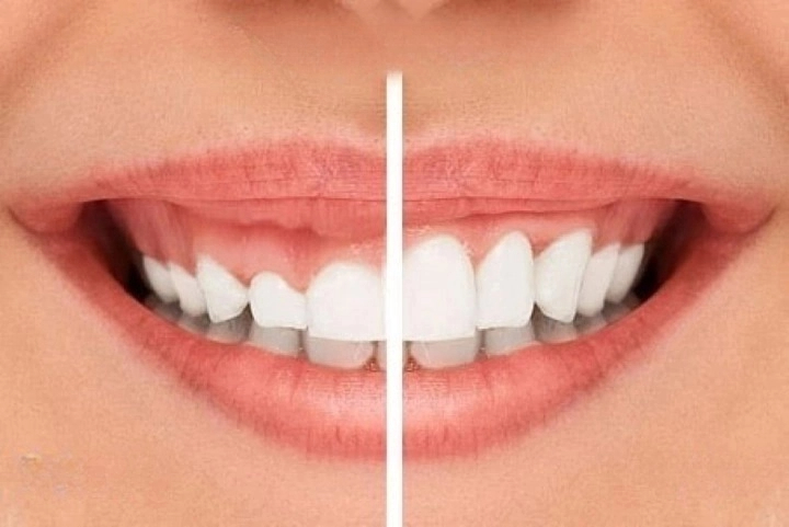 Diş Eti Seviyeleme Nedir?