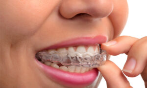 Şeffaf Plak Tedavisi Nedir?