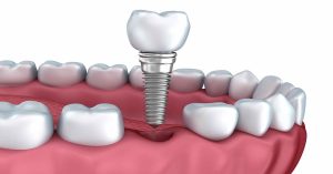 Aynı Gün İmplant Tedavisi Hakkında